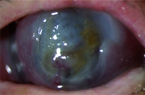 Figure 2 Corneal graft perforation with iris prolapse.