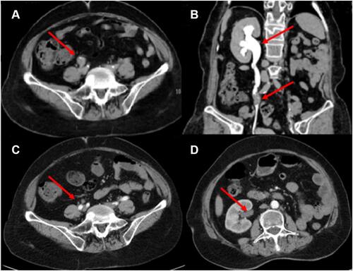 Figure 3 CT urogram. (A) Tumor recurrence in the middle right ureter (red arrow). (B) As a result of blockage in the middle ureter, the right hydronephrosis expanded (red arrow). (C) After 3 cycles of a combination of pembrolizumab and erdafitinib, the thickening of the wall of the right middle ureter was significantly reduced (red arrow). (D) The expansion of the right renal pelvis and the effusion were obviously disappeared (red arrow).