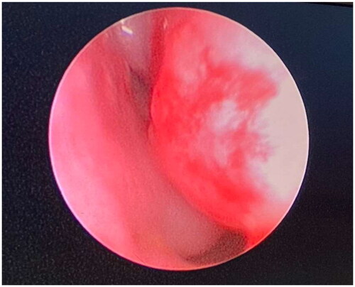 Figure 1. Nasal endoscopic picture of right nasal cavity of patient 1 showing deviated nasal septum touching the inferior turbinate.