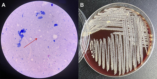 Figure 2 The results of staining and culture. (A) Weak acid-fast staining of the abscess wall (×1000). (B) An image of pure bacteria after 10 days of culture.