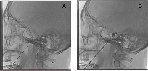 Figure 1 The image of trigeminal ganglion block and trigeminal ganglion compression. (A) Trigeminal ganglion block was performed under radiation. (B) The inflated balloon compressed the trigeminal ganglion.