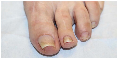 Figure 1. Pincer nail of the left first toenail in an 80-year-old woman. The lateral aspect of the nail plate is penetrating the periungual dermis of the lateral nail fold [Citation8].