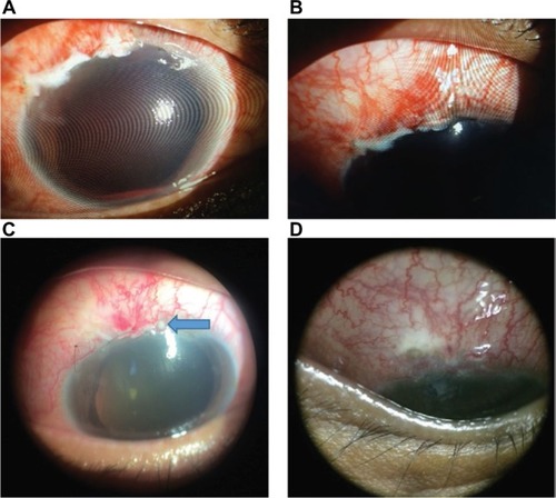 Figure 6 Right eye post-trabeculectomy (A) with close-up view (B), complicated with suture abscess (blue arrow) (C) and followed with blebitis (D).