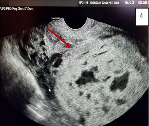 Figure 4. (Same findings as Figure 3): transvaginal sonography, abdominal lacunae grade III; specific wall of ‘clear space’ around the cervix (red arrow); subplacental hypervascularity, placenta previa totalis: anterior and posterior.