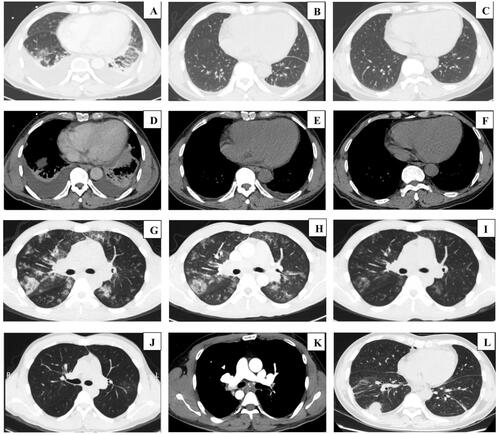 Figure 1. Chest CT showing patches and consolidation, and bilateral pleural effusion. The lesion disappears after applying glucocorticoid combined with deworming drugs. (A,D) before treatment, (B,E) after 7 days of treatment, (C,F) after 7 weeks of treatment (patients from the parasite HES group). Chest CT showing extensive ground-glass exudation and patches shadow in both lungs, the lesion is gradually absorbed after glucocorticoid therapy: (G) before treatment; (H) after 2 days of treatment; (I) after 5 days of treatment; (J) after 9 weeks of treatment (patients from the idiopathic HES group). Chest CT shows pulmonary embolism (K) and nodule (L). CT, computed tomography; HES, hypereosinophilic syndrome.