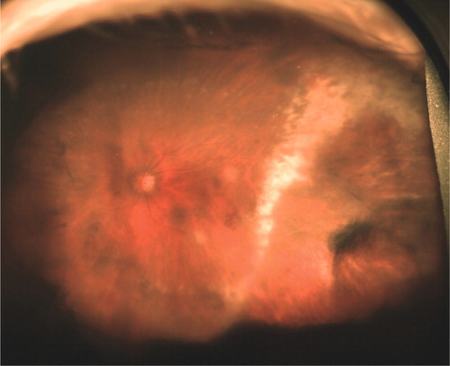 Figure 3. Wide-field fundus photograph demonstrating large area of temporal retinitis and faint laser scarring.