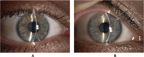 Figure 1 Slit lamp biomicroscopic images. (A) The right eye of a 28-years-old male patient after 12 months from Descemetic DALK. (B) The right eye of a 35-years-old female patient’s eye after 6 months from PK. Both corneas are clear assessing the success of the transplant and a 10–0 nylon double-running 12 bites continuous suture is visible.