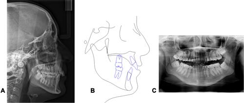 Figure 12 Clinical case 2: initial lateral head film (A), cephalometric tracing (B) and panorex (C).