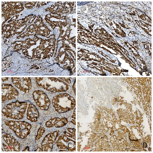 Figure 1. Immunohistochemical PMS2, MLH1, MSH2, and MSH6 study in four different colorectal carcinoma cases. (A) Strong nuclear MLH1 expression, (B) Strong nuclear MSH2 expression, (C) Strong nuclear MSH6 expression, (D) Strong nuclear PMS2 expression in pMMR cases (immunoperoxidase, 100×). Scale bar = 500 µm.