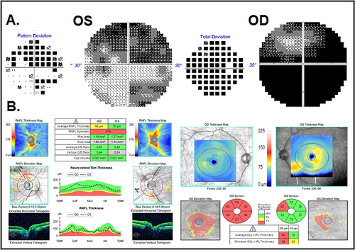 Figure 2 Case on 4-month follow-up. (A) Visual fields showing bilateral improvement; right eye mean deviation −27.1 dB and left eye mean deviation −15.1 dB. (B) OCT showing improved disc edema bilaterally and ganglion cell complex thinning, right eye worse than left eye.