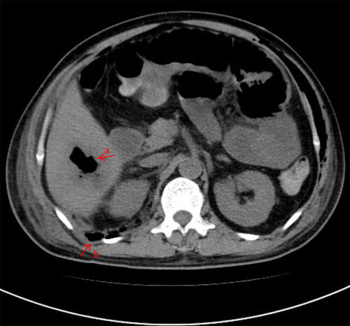Figure 1 CT image showing liver abscess, multiple gas accumulation and dilation in the bowel, and retroperitoneal infection. a. Liver abscess; b. Retroperitoneal infection.