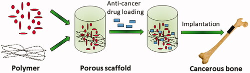 Figure 1. Schematic illustration of local anticancer drug delivery.