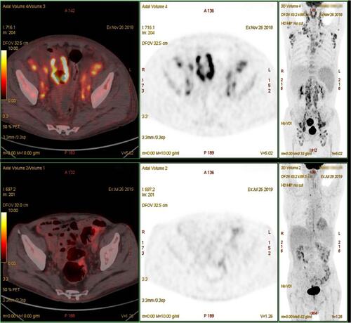 Figure 3 Comparison of positron emission tomography/computed tomography scans before and after lenalidomide-combination treatment.