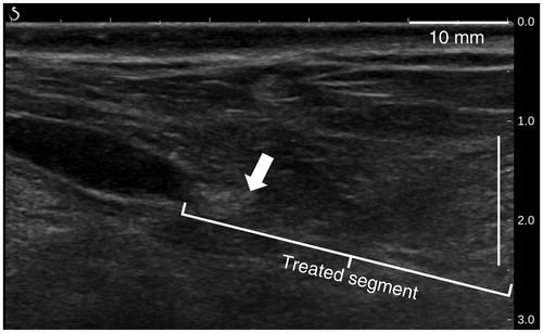Figure 11. B-mode image of a sheep vein (white arrow) taken 90 days after sonications and showing complete fibrosis of the treated segment.