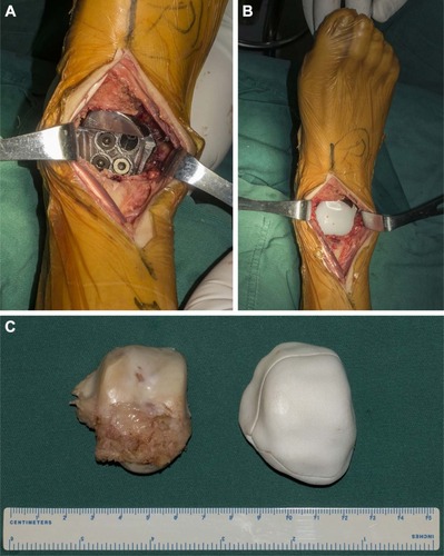 Figure 4 The intraoperative pictures.