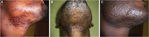 Figure 6 Papules and pustules on the anterior neck, chin, and cheeks (A); PFB affecting mainly the anterior neck region (B); keloids resulting from lesions from PFB (C).