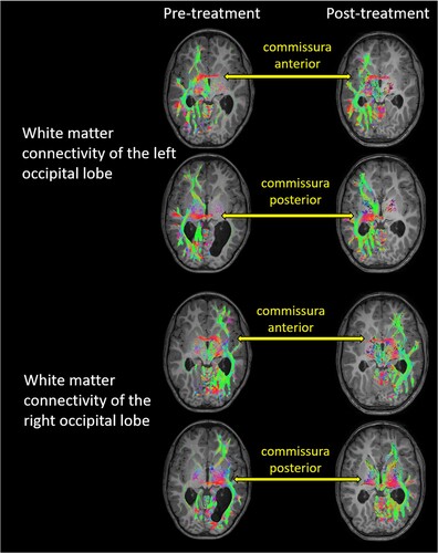 Figure 4. White matter connectivity of the left and right occipital lobes before and after treatment, overlaid on the individual structural T1, neurological convention. The occipital lobes showed connectivity to ipsilateral temporal and frontal brain regions. Interhemispheric connectivity was possible through the anterior and posterior commissure. The colour-coding of tractography pathways is based on a standard red-green-blue (RGB) code that was applied to the vector in each brain area to show the spatial locations of terminal regions of each pathway (red for right-left, blue for cranial-caudal, and green for anterior-posterior). As pre- and post-treatment T1 images were taken at two different measurement time points, the orientation of the head within the scanner was not identical, and slices differed to some degree.