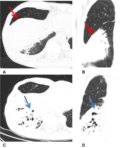 Figure 4 Pulmonary MALT lymphoma in a 68-year-old woman. (A and B) Thin-section CT and multi-planar reconstruction showed a consolidation with a bulging fissure (red arrow) in right lower lobe. (C and D) The patient received chemotherapy. However, 1 year later, chest CT imaging showed that area of the consolidation in lower right lobe became larger than before, and the dilated bronchus could be seen (blue arrow), which means the condition progressed.