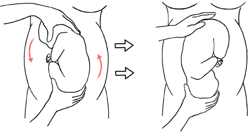 Figure 2 The fetal spine is on the left side of the abdomen. The practitioner held the fetal head in their left hand and the fetal buttocks in their right hand. The practitioner applied gentle pressure, pushing the fetal head toward the pubic symphysis in a counterclockwise forward roll motion with the left hand, while simultaneously guiding the fetal buttocks counterclockwise toward the uterine fundus with the right hand.