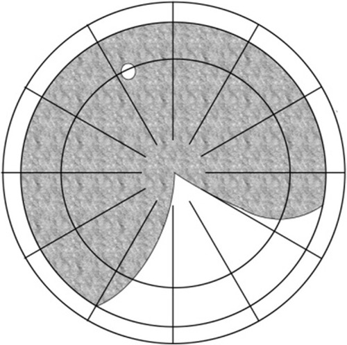 Figure 8 Group 6: detachments across both the superior vertical and horizontal midlines.