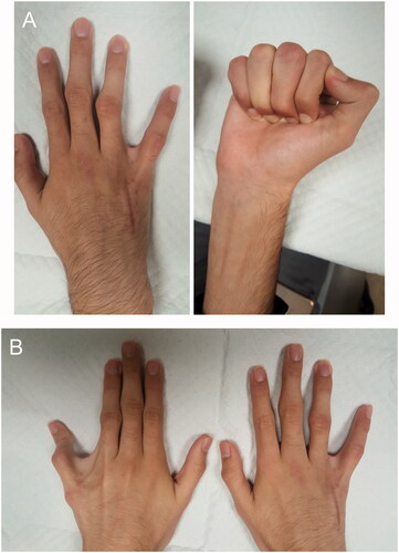 Figure 3. Postoperative photographs of the patient’s (A) right hand and (B) both hands taken at 4 months after surgery. The left hand has not been surgically corrected.