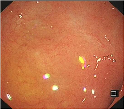 Figure 6 A follow-up gastroscopic examination after six months showed scarring changes in the duodenal bulbar ulcer.