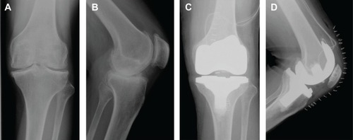 Figure 4 Anteroposterior and lateral knee radiographs of case 2 (46-year-old male).