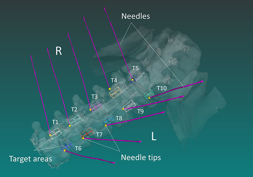 Figure 6 Targeting error analysis. The targeting error was defined as the shortest distance between the final point of the needle tip (yellow spheres) and the target area designated in the preoperative planning.