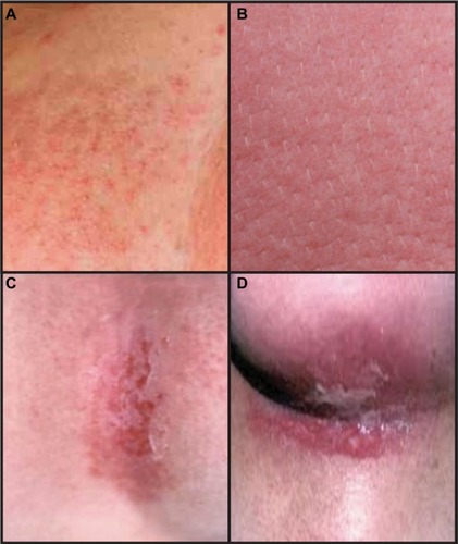 Figure 1 Common skin reactions in patients receiving breast radiation therapy.