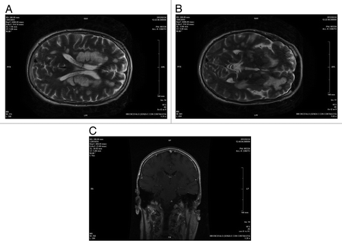 Figure 2. AxialT2encephalic magnetic resonance (A and B), coronal T1 post Gd (C) sequences performed about 1 mo after clinical onset of symptoms and after therapy: supratentorial and infratentorial demyelinating lesions were unchanged with overall dimensions slightly reduced and negative enhancement.