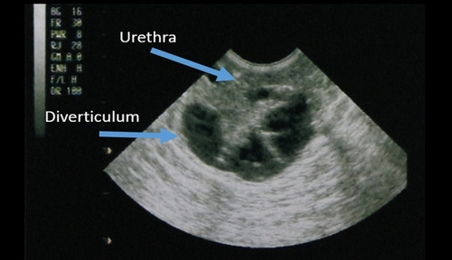 Figure 4 Transvaginal ultrasound axial view shows complex urethral diverticulum as hypoechoic region around urethra.