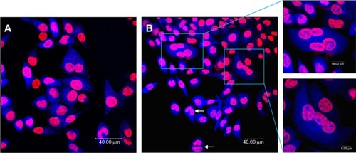 Figure 3 Multinucleation in L-02 cells induced by silica nanoparticles. (A) Control group and (B) group treated with100 μg/mL silica nanoparticles. The cell nucleus and cytoplasm were stained by Hoechst 33258 and fluorescein diacetate, respectively. Binucleated cells (arrows) and multinucleated cells (amplification) were observed.