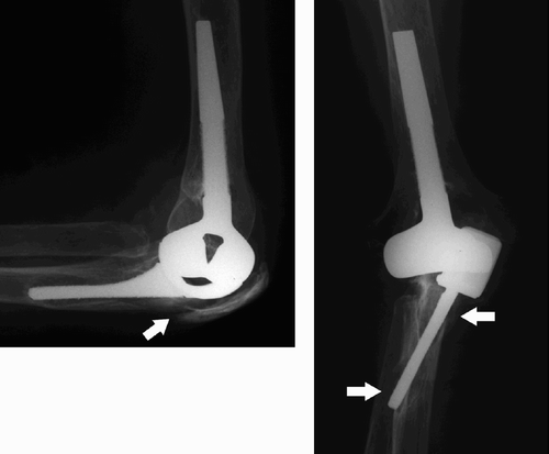 Figure 5. Lateral and AP radiographs of the same prosthesis at the time of revision (4.6 years after implantation); osteolysis around the ulnar stem has caused fracture of the ulna (white arrows).