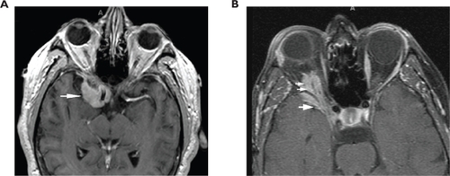 Figure 5 T1-weighted, axial MRIs after intravenous injection of paramagnetic contrast material in two cases of biopsy-proven sphenoid wing meningiomas. (A) Note similarity of enhancing lesion (arrowhead) that surrounds the right anterior clinoid process to the appearance of the lesion in Case 1. (B) Note similarity of enhancing lesion that involves the right orbit (small double arrowheads) as well as the medial sphenoid wing around the temporal lobe tip (large single arrowhead) to our Case 2.