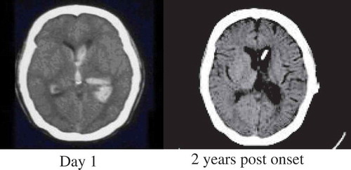 Figure 1. Computed tomography of the patient’s brain.Left thalamic hemorrhage with ventricle rupture as seen immediately after the hemorrhage (day 1), and the same area at year 2 post onset. The lesion mainly involved middle-to-posterior parts of the thalamus, including the pulvinar, lateral posterior, centromedian, and reticular nuclei.