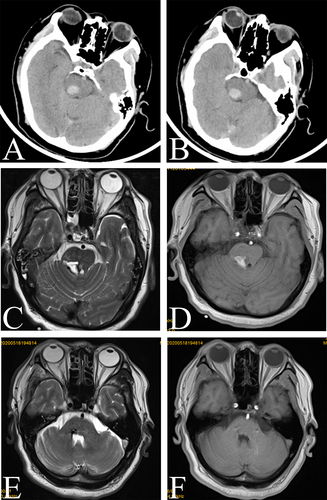 Figure 1 Image of a right pontine hemorrhage near the red nucleus. (A and B) Preoperative computed tomography image showing acute intracerebral hemorrhage in the right pons near the red nucleus. (C and D) MR image showing that the brainstem hemorrhage was located in the right pontine arm. (E and F) Preoperative T2-weighted and T1-weighted axial magnetic resonance images revealing the resolution of hemorrhage. Encephalomalatic changes, cystic degeneration, and hemosiderin around the lesion were also absorbed.