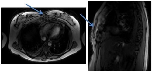Figure 3 Magnetic resonance imaging of the chest.