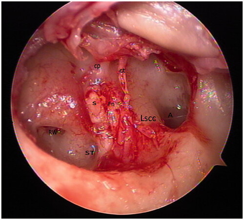 Figure 3. Endoscopic wide-angle view. Abbreviations: A: antrum; cp: cochlearifom process; ct: chorda tympani; Fn: dehiscent tympanic segment of facial nerve; Lscc: lateral semicircular canal; ST: sinus tympani; RW: round window.