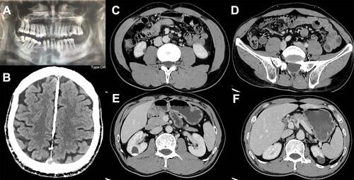 Figure 2 Radiographic findings. (A) Panoramic radiograph of the oral cavity revealed multiple odontogenic keratocysts; (B) Skull computed tomography showed calcification of the falx cerebri; (C–F) Contrast-enhanced computed tomography of the abdomen revealed mesenteric and para-aortic nodules, bilateral renal cysts (the right one-Bosniak grade III).