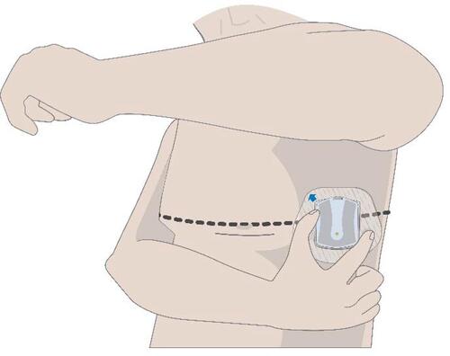Figure 1 Illustration of the µCor device in the side location of a subject. The device emits radiofrequency signals which propagate through the lungs and are reflected back to the device. Changes in the reflected radar wave signal indicate changes in fluid accumulation.