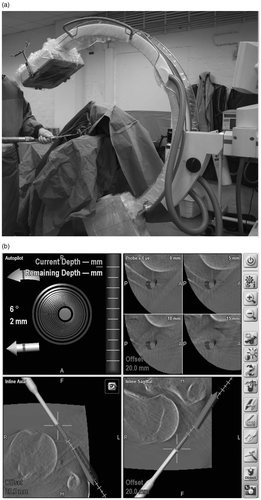 Figure 1. Laboratory set-up. (a) Positioning on the radiolucent table with the flat detector 3D C-arm. The Kirschner wire is navigated via a navigated drill guide. The reference marker is attached to the spina scapulae. (b) Screenshot of a navigated AC joint transfixation. The upper left panel shows the aiming trajectory; the other panels show the planned trajectory.