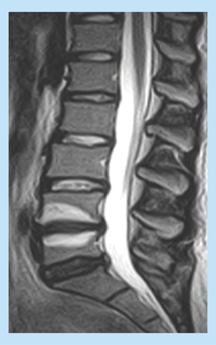 Figure 1.  An MRI T2-weighted image.Typical Modic changes type 1 (high signal intensity) in a lumbar segment. Reproduced with permission from [Citation4].