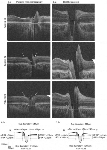 Figure 7. Left column: Patient 17 (microcephaly lymphedema chorioretinal dysplasia) with smaller disc (bracket) and cup (line) diameter. Patient 22 (possible progressive encephalopathy with edema, hypsarrhythmia, and optic atrophy [PEHO]) with reduced peripapillary retinal nerve fiber layer (RNFL) thickness (arrows) and smaller disc (bracket) and cup (line) diameter. Patient 23 (possible PEHO) with reduced peripapillary RNFL thickness (arrows) and smaller disc (bracket) and cup (line) diameter. Right column: Healthy controls. Lower panel: Cross-sectional schematic diagrams represent mean values of optic nerve head measures of patients with microcephaly (left) and controls (right). Upper horizontal dotted lines represent horizontal offset (150 μm) used to determine cup diameters, and lower horizontal dotted lines indicate disc horizontal diameters. Vertical dotted lines show margins of rim areas. Significant values are marked with an asterisk. CDR = cup-to-disc ratio; n = nasal; t = temporal. Reprinted with permission from [Citation110], licensed under https://creativecommons.org/licenses/by/4.0/.