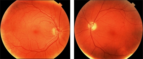 Figure 3 Fundus photo showing inferotemporal disc pallor in the left eye.