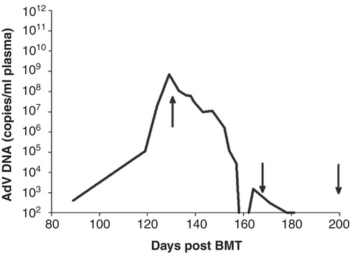 Figure 2. Plasma adenovirus (AdV) levels prior to (day +132 posttransplant) and during (day +133) treatment with brincidofovir (BCV). AdV was first detected day +89 posttransplant, with a continued rise in AdV load despite administration of intravenous cidofovir days +92 – +132 posttransplant and intravenous immunoglobulin (IVIG) (day +129 posttransplant). Treatment with BCV was initiated on day +133 posttransplant at 2 mg/kg administered twice weekly increasing to 3 mg/kg after the sixth dose. After the virus became undetectable (less than 1012 copies/ml) (day +159 posttransplant), administration of BCV continued at 3 mg/kg but the schedule was reduced to once weekly for maintenance. Arrows indicate timing of 1st, 10th, and 20th BCV doses.