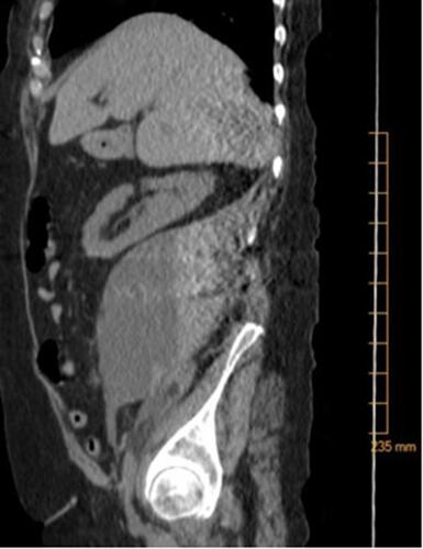 Figure 1 CT of abdomen and pelvis without contrast, showing large right-sided retroperitoneal mass (10×11×16 cm) concerning for hematoma of varying age.