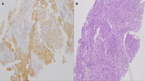 Figure 6 PD-L1 expression to the relapse site (nodule under the diaphragm).Notes: (A) Programmed death-ligand 1-positive case with whole membranous staining (intense 1+ and 2+) in 90% of neoplastic cells; (B) hematoxylin/eosin of the same case (undifferentiated lung adenocarcinoma), magnification ×100.