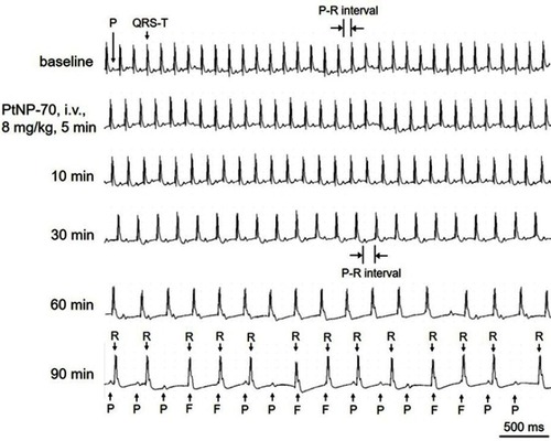 Figure 7 Representative ECGs showing the effects of intravenous PtNP-70 (8 mg/kg) on the heart rate and rhythm of a mouse in vivo. PtNP-70 at this dose had similar effects on the heart rate and rhythm as that did by PtNP-5, ie, the ECGs successively showed heart rate slowing, P-R interval prolongation and complete atrio-ventricular conduction block (AVB), but the animals did not die within the observed 90 mins.Abbreviations: P, P wave; QRS-T, QRS complex and T wave; F, fusion of P wave with QRS complex; R, R wave.