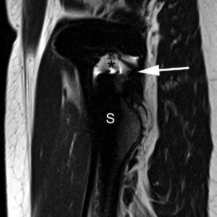Figure 1. Mild adverse reaction to metal debris. Sagittal T2W MR through the femoral stem (S) of a Corail total hip replacement demonstrating mild periprosthetic disease. A small fluid-filled cavity (asterisk) surrounding the neck of the prosthesis is encapsulated by a thick, ragged low-signal rim (white arrow).