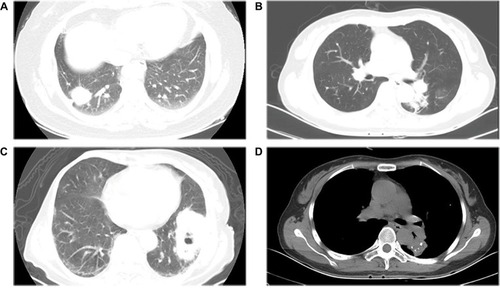 Figure 2 The four special signs seen on the CT images.Note: (A) pleural indentation; (B) air bronchogram; (C) cavitation; (D) calcification.Abbreviation: CT, computed tomography.